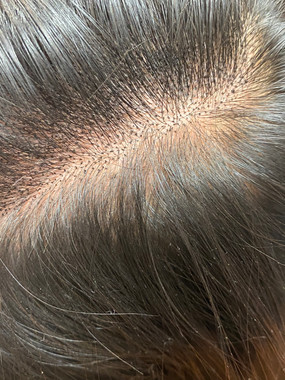 Scalp Micropigmentation