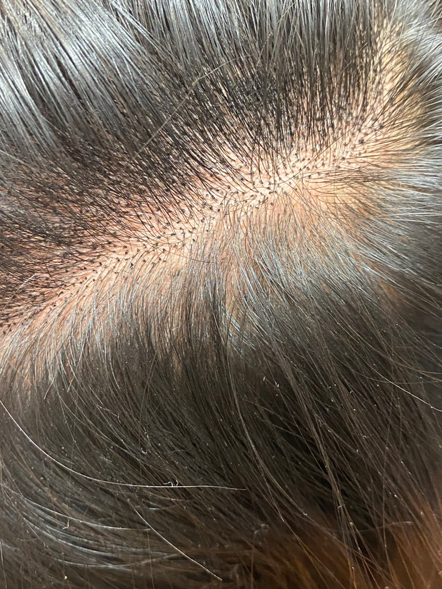 Scalp Micropigmentation