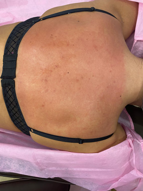 Microneedling