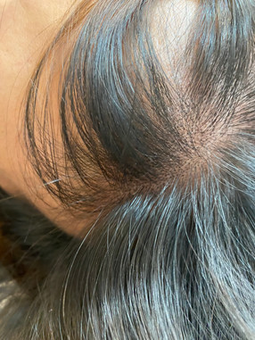 Scalp Micropigmentation