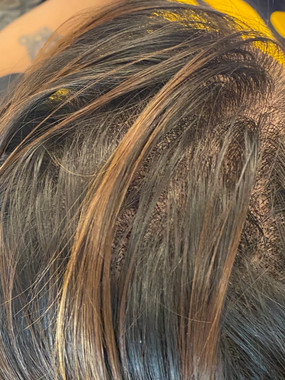 Scalp Micropigmentation