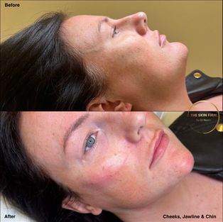 Image showcasing dermal filler injections in the jawline, chin, and cheeks for defined facial features.