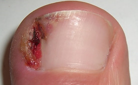 Ingrown Nail_edited.jpg