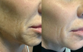 Ablative Skin Resurfacing.jpeg