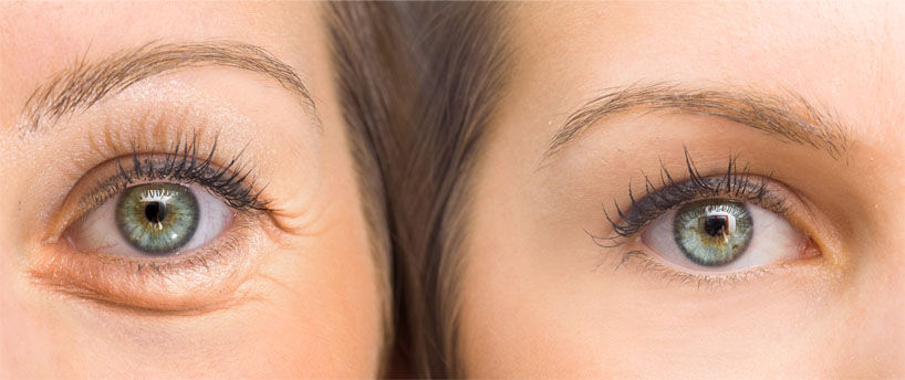 Puffiness under the eyes caused by caffeine (left) Clear, Calm eyes (right)