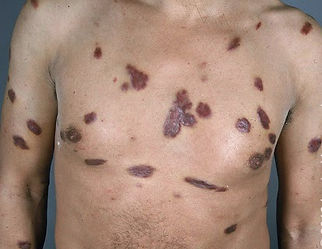 Kaposi arcoma affecting the skin.jpg