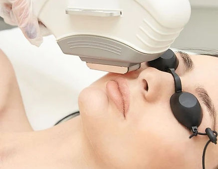 Laser Hair Removal on face