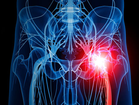 Išijas: klinički okvir, uzroci, mitovi i terapijski pristup