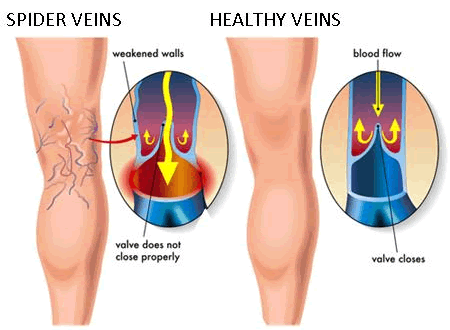 Spider Veins.gif