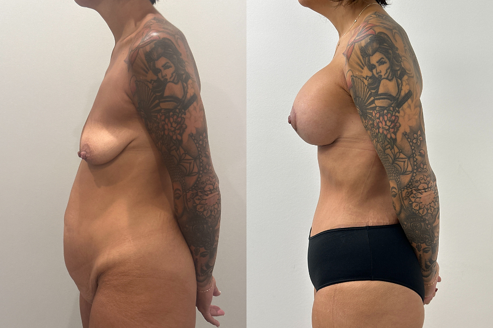 A before-and-after shot of long-lasting mommy makeover results.