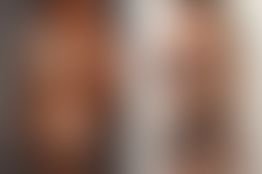 Before and after images of a woman in underwear, highlighting mommy makeover scars and changes in breast appearance.