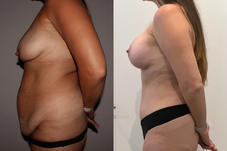 Before and after images of a woman in underwear, highlighting mommy makeover scars and changes in breast appearance.