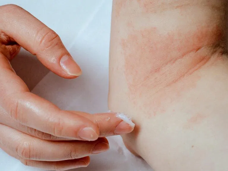 What is Eczema? And All You Need to Know