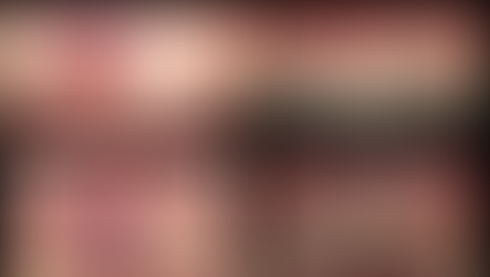 前歯の審美インプラント(歯茎移植、骨造成) 船橋