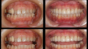 主訴:どこで噛んでいいかわからない。(インプラント、矯正治療、噛み合わせ治療、審美治療) 船橋