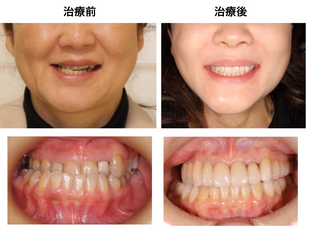 顎が痛くて口が開かない。顔が歪んでいる。食事できない。不定愁訴がひどい（54歳女性）