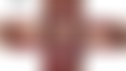 重症の歯周病治療後　１０年経過　（船橋）（主訴：歯茎が下がってきた、歯が前に出てきた）