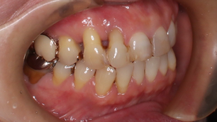 歯医者で定期検診を受けていたのに歯が抜けそう。重度歯周病（セカンドオピニオン）（船橋）