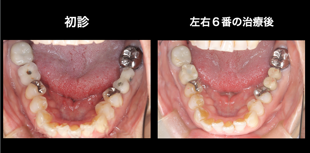 インプラントレスキュー（主訴：インプラントした部分のセラミックが