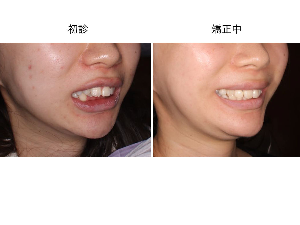 船橋市つかだ歯科医院　矯正症例