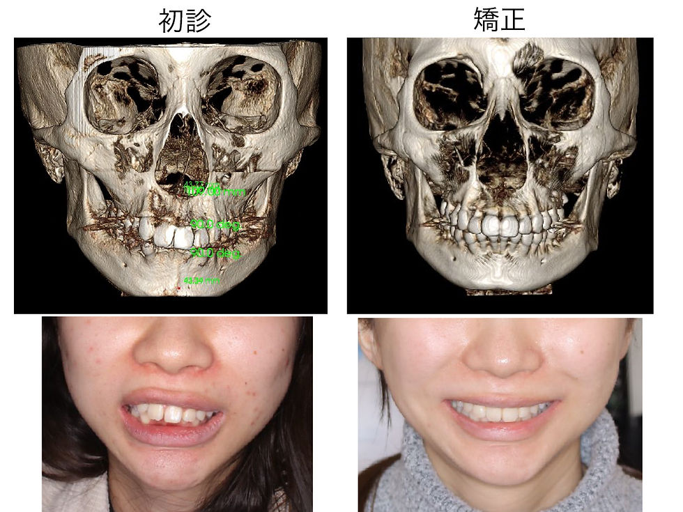 船橋市つかだ歯科医院　矯正症例
