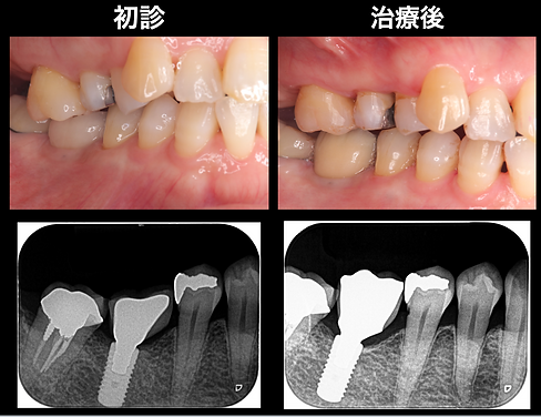 インプラントレスキュー（主訴：インプラントした部分のセラミックが