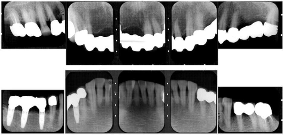つかだ歯科医院　歯周組織再生療法症例