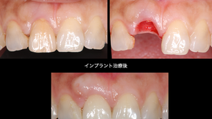 前歯のインプラント 審美歯科治療(船橋)