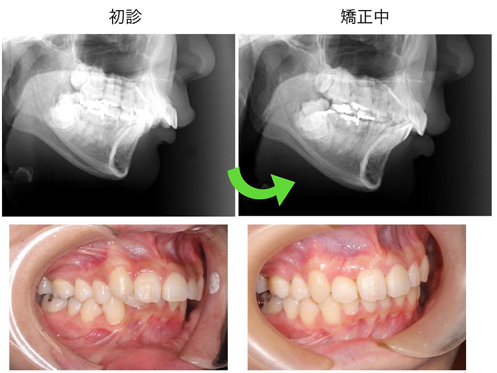 船橋市つかだ歯科医院　矯正症例