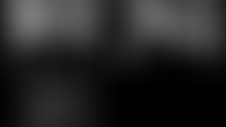 歯を残す顕微鏡での精密根管治療　CTとマイクロスコープの応用