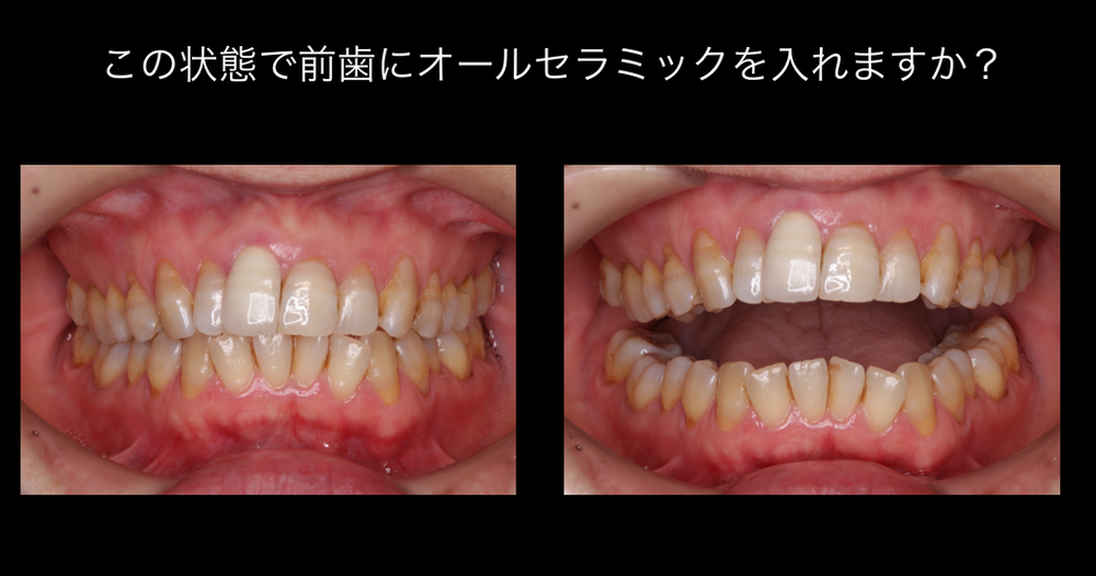歯並びがとても悪く矯正したいです しかしお金がありません 前歯だけ オーラルケア ホワイトニング 歯科矯正 教えて Goo