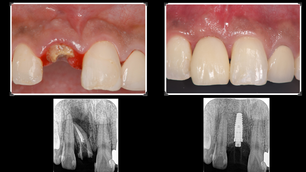 前歯のインプラント（船橋）