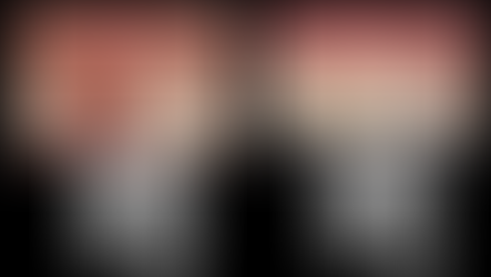 前歯のインプラント(船橋)