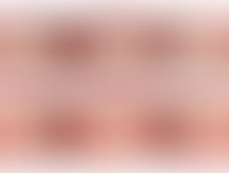 右側の噛み合わせが低くて、噛み合わせがおかしい（20代前半・女性）