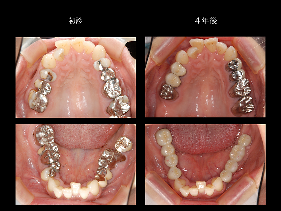 つかだ歯科医院 インプラント治療例