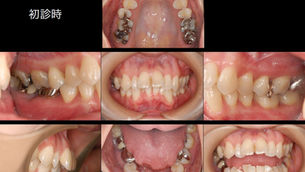 歯を長持ちさせたい（38歳・女性）