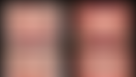 噛み合わせを考えた 抜歯矯正の症例(船橋)