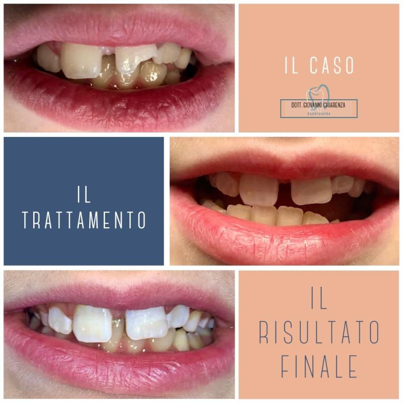 incisivo rotto dopo trauma e ricostruito in composito