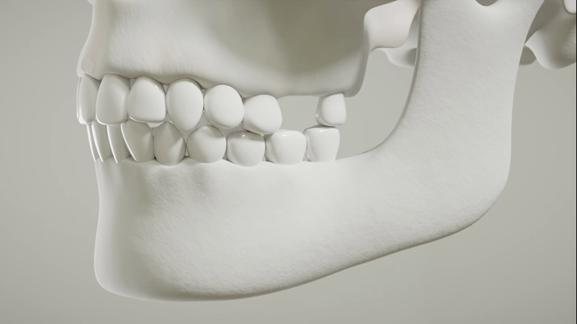 [포폴]+치과+Sinus+Lift+-+251118.gif