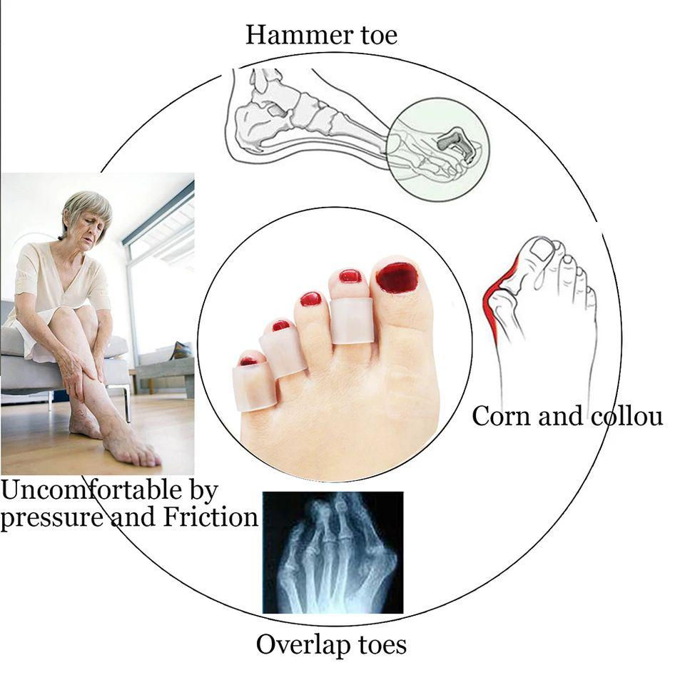 الصورة المصغرة: فاصل الاصابع الطبى السيلكون عدد 5 قطع بالعبوة-Medical silicone finger separator