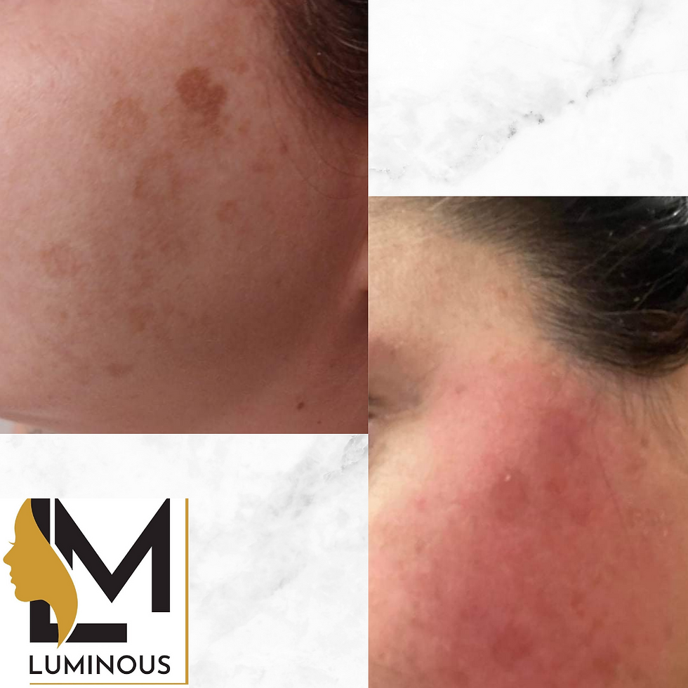 pigment treatment