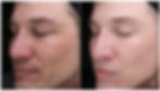 vi chemical peels