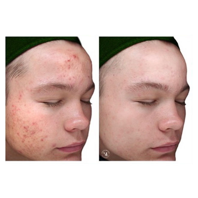 Vi chemical peel
