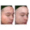 Vi chemical peel