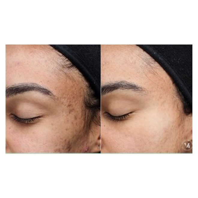 Vi chemical peel