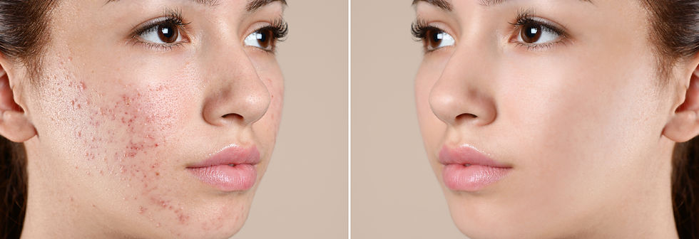 acne bootcamp miami