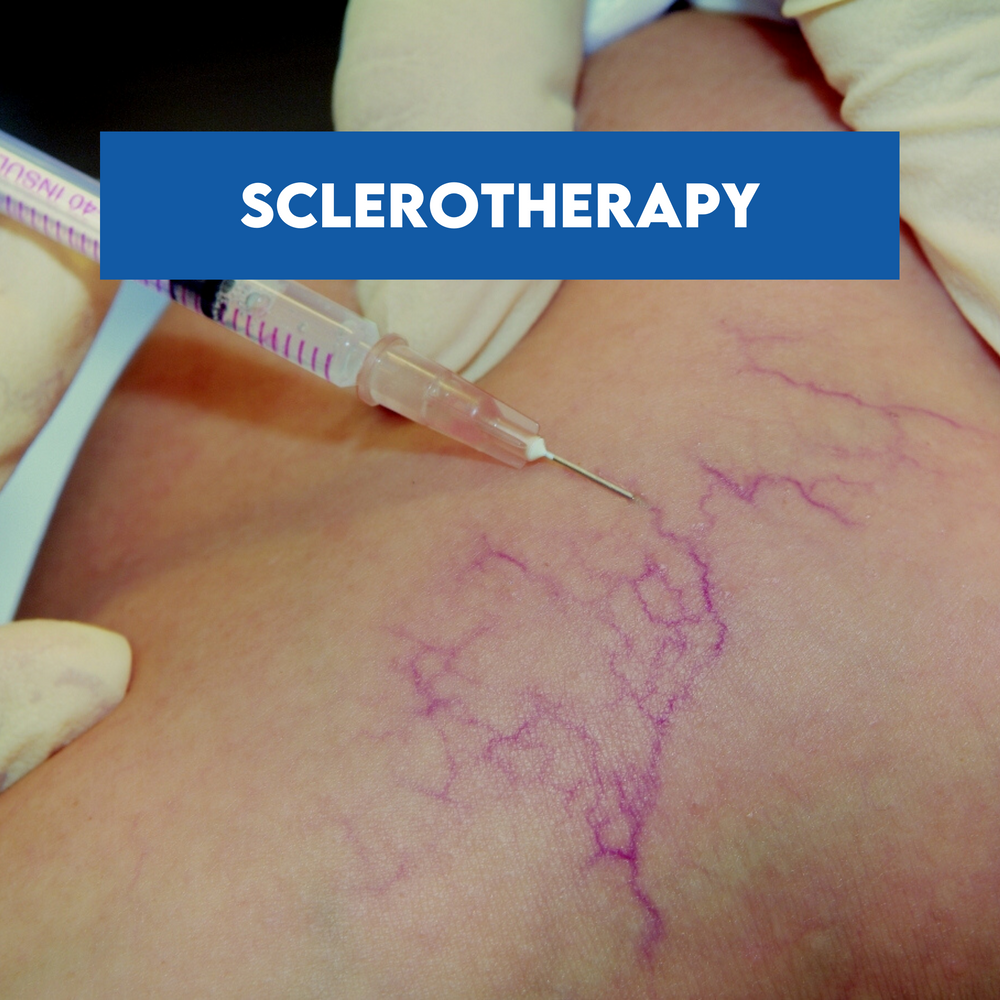What is Sclerotherapy?