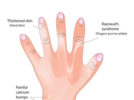 Rare but mighty: Systemic sclerosis