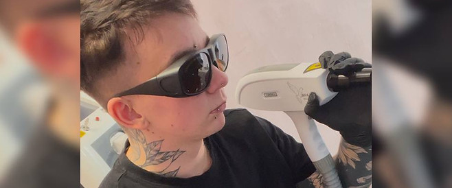 Lev, laser tech using a ND Q-Switched YAG laser. wearing protective eye wear and gloves