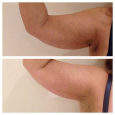 Cryo-Slimming